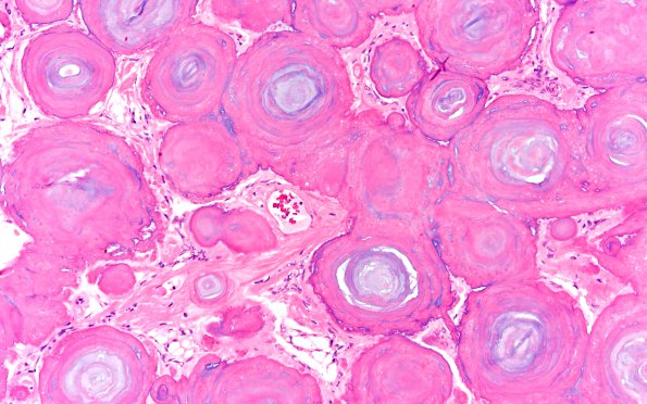 11A3 Meningioma, psammomatous (Case 11) 20X