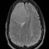 12A1 Meningioma, psammomatous (Case12) FLAIR - Copy