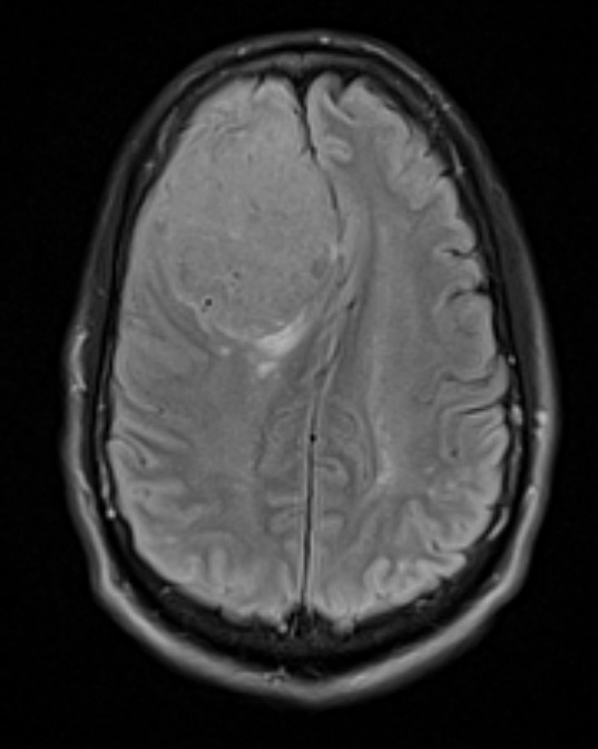 12A1 Meningioma, psammomatous (Case12) FLAIR - Copy