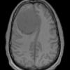 12A2 Meningioma, psammomatous (Case12) T1noC - Copy