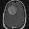 12A3 Meningioma, psammomatous (Case12) T1W - Copy