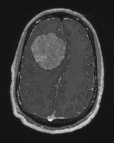 12A3 Meningioma, psammomatous (Case12) T1W - Copy