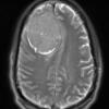 12A4 Meningioma, psammomatous (Case12) T2noC - Copy