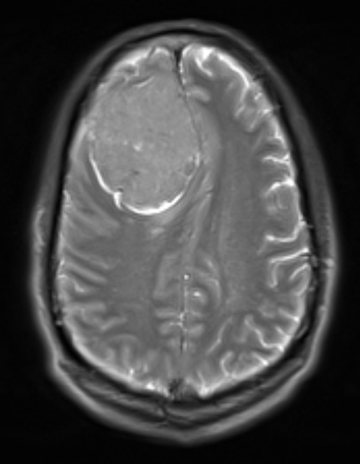 12A4 Meningioma, psammomatous (Case12) T2noC - Copy