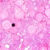 12B1 Meningioma, psammomatous (Case12) 10X