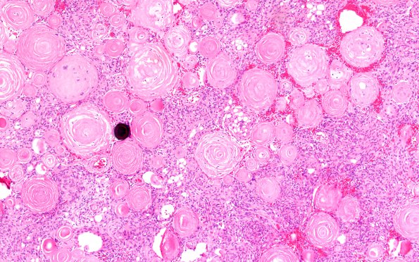 12B1 Meningioma, psammomatous (Case12) 10X