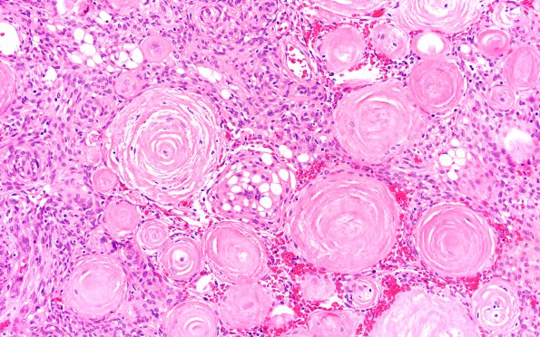 12B2 Meningioma, psammomatous (Case12) 20X 1