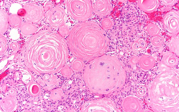 12B3 Meningioma, psammomatous (Case12) 20X 2