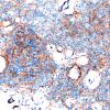 12C1 Meningioma, psammomatous (Case12) EMA 20X 2