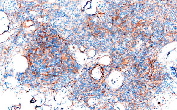 12C1 Meningioma, psammomatous (Case12) EMA 20X 2