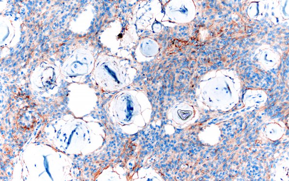 12C2 Meningioma, psammomatous (Case12) EMA 20X 3