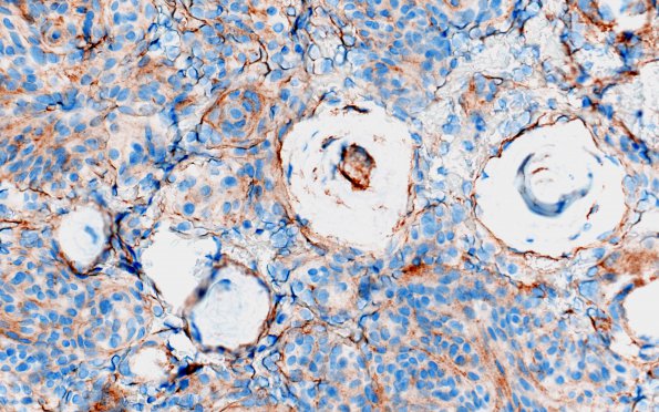 12C3 Meningioma, psammomatous (Case12) EMA 40X