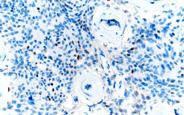 12D2 Meningioma, psammomatous (Case12) PR 40X