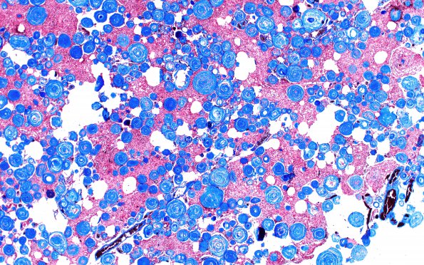 12E1 Meningioma, psammomatous (Case12) Trichrome 4X