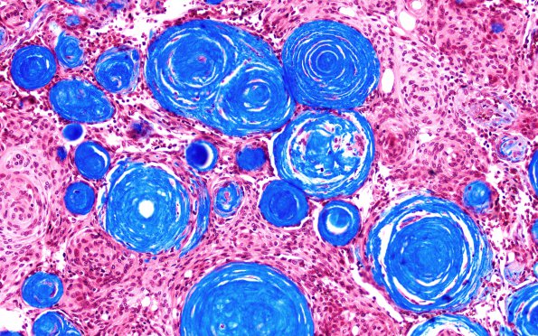 12E3 Meningioma, psammomatous (Case12) Trichrome 20X