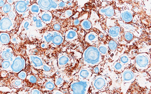 13B2 Meningioma, psammomatous (Case 13) EMA 20X