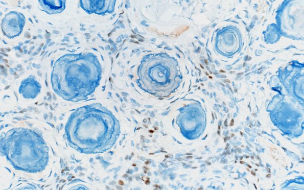 13C Meningioma, psammomatous (Case 13) PR 40X