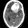 1A1 Meningioma, atypical with psamommas (Case 1) CT with Contrast - Copy