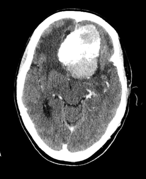 1A1 Meningioma, atypical with psamommas (Case 1) CT with Contrast - Copy