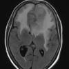 1A2 Meningioma, atypical with psamommas (Case 1) FLAIR - Copy