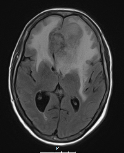 1A2 Meningioma, atypical with psamommas (Case 1) FLAIR - Copy