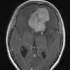 1A3 Meningioma, atypical with psamommas (Case 1) T1W - Copy