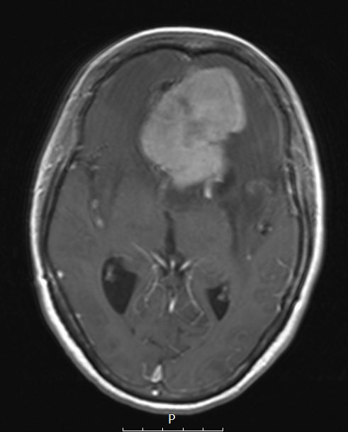 1A3 Meningioma, atypical with psamommas (Case 1) T1W - Copy