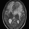 1A4 Meningioma, atypical with psamommas (Case 1) T2noC - Copy