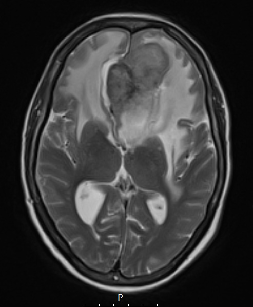 1A4 Meningioma, atypical with psamommas (Case 1) T2noC - Copy