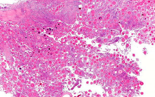 1B1 Meningioma, atypical with psamommas (Case 1) H&E 2X