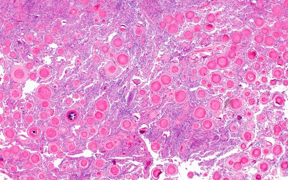 1B2 Meningioma, atypical with psamommas (Case 1) H&E 4X