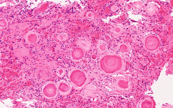 1B3 Meningioma, atypical with psamommas (Case 1) H&E 1