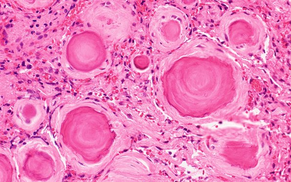 1B4 Meningioma, atypical with psamommas (Case 1) H&E 2