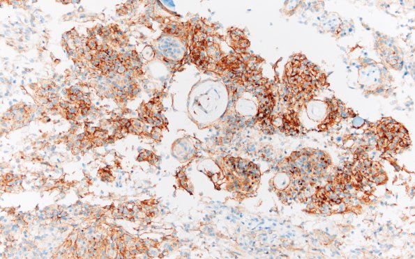 1C Meningioma, atypical with psamommas (Case 1) EMA 20X