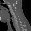 2A1 Psammomatous Meningioma (Case 2) CT 3 copy - Copy