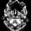 2A2 Psammomatous Meningioma (Case 2) CT 6 copy - Copy