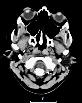 2A2 Psammomatous Meningioma (Case 2) CT 6 copy - Copy