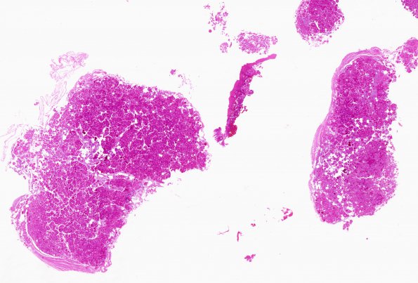 2B1 Meningioma, psamommatous (Case 2) H&E 5