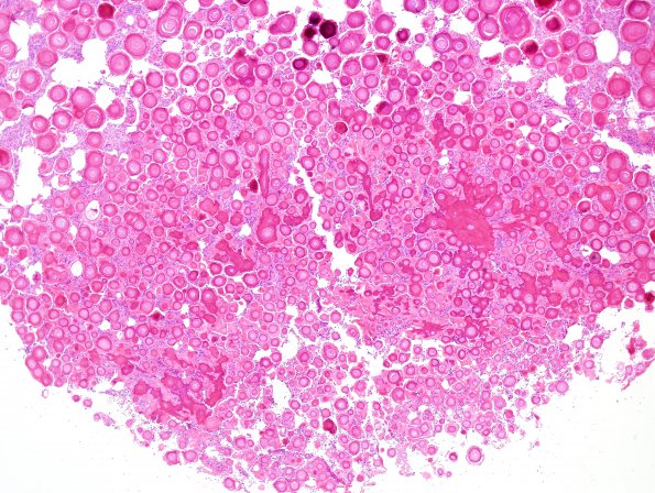 2B2 Meningioma, psamommatous (Case 2) H&E 4