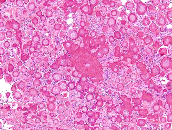 2B3 Meningioma, psamommatous (Case 2) H&E 3