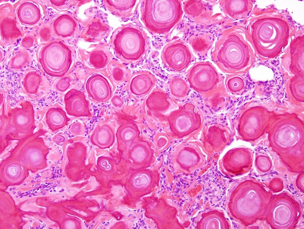 2B4 Meningioma, psamommatous (Case 2) H&E 2