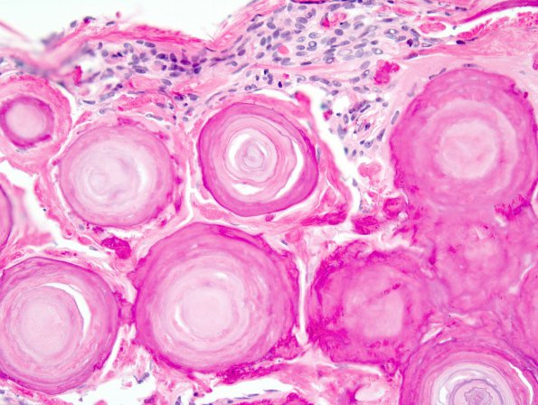 2B5 Psammomatous Meningioma (Case 2) 4.jpg