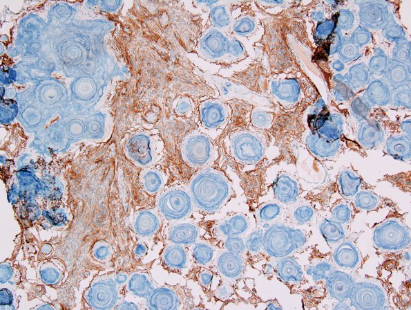 2C1 Psammomatous Meningioma (Case 2) EMA 1.jpg