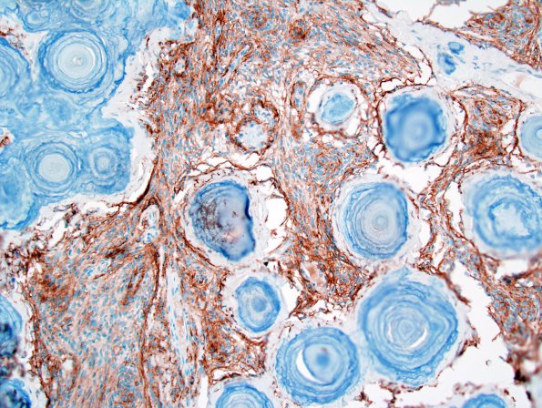 2C2 Psammomatous Meningioma (Case 2) EMA 2.jpg