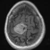 3A1 Meningioma, Hyalinized, psammomatous (Case 3) T1W - Copy