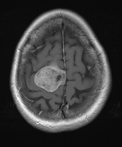 3A1 Meningioma, Hyalinized, psammomatous (Case 3) T1W - Copy