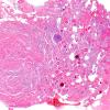 3B1 Meningioma, Hyalinized, psammomatous (Case 3) H&E 2X