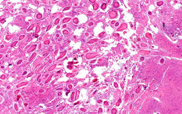 3B2 Meningioma, Hyalinized, psammomatous (Case 3) H&E 4X