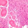 3B3 Meningioma, Hyalinized, psammomatous (Case 3) H&E 5