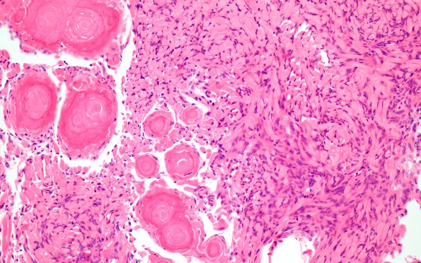 3B3 Meningioma, Hyalinized, psammomatous (Case 3) H&E 5